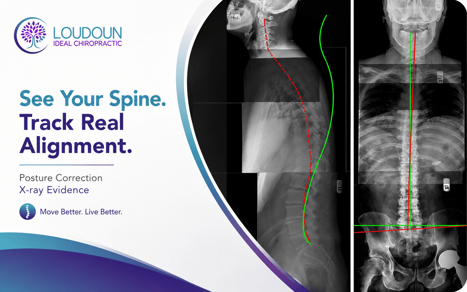 Posture Correction X-ray Evidence