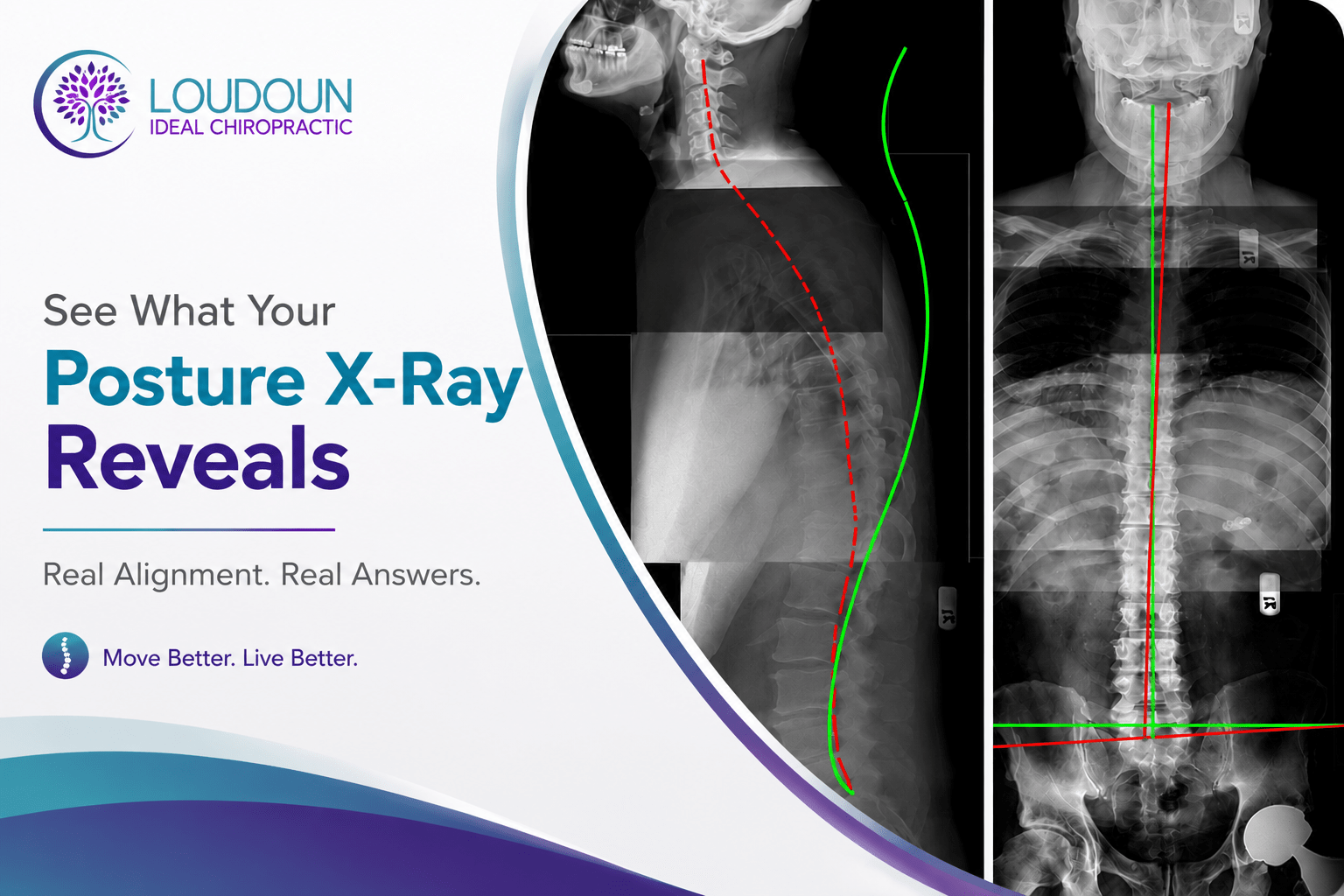 Posture X-Ray Analysis